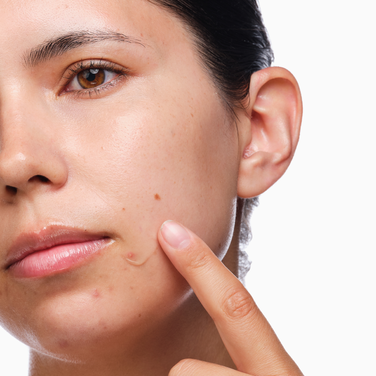 the-acne-set-b2 rdn-the-acne-set-application.png