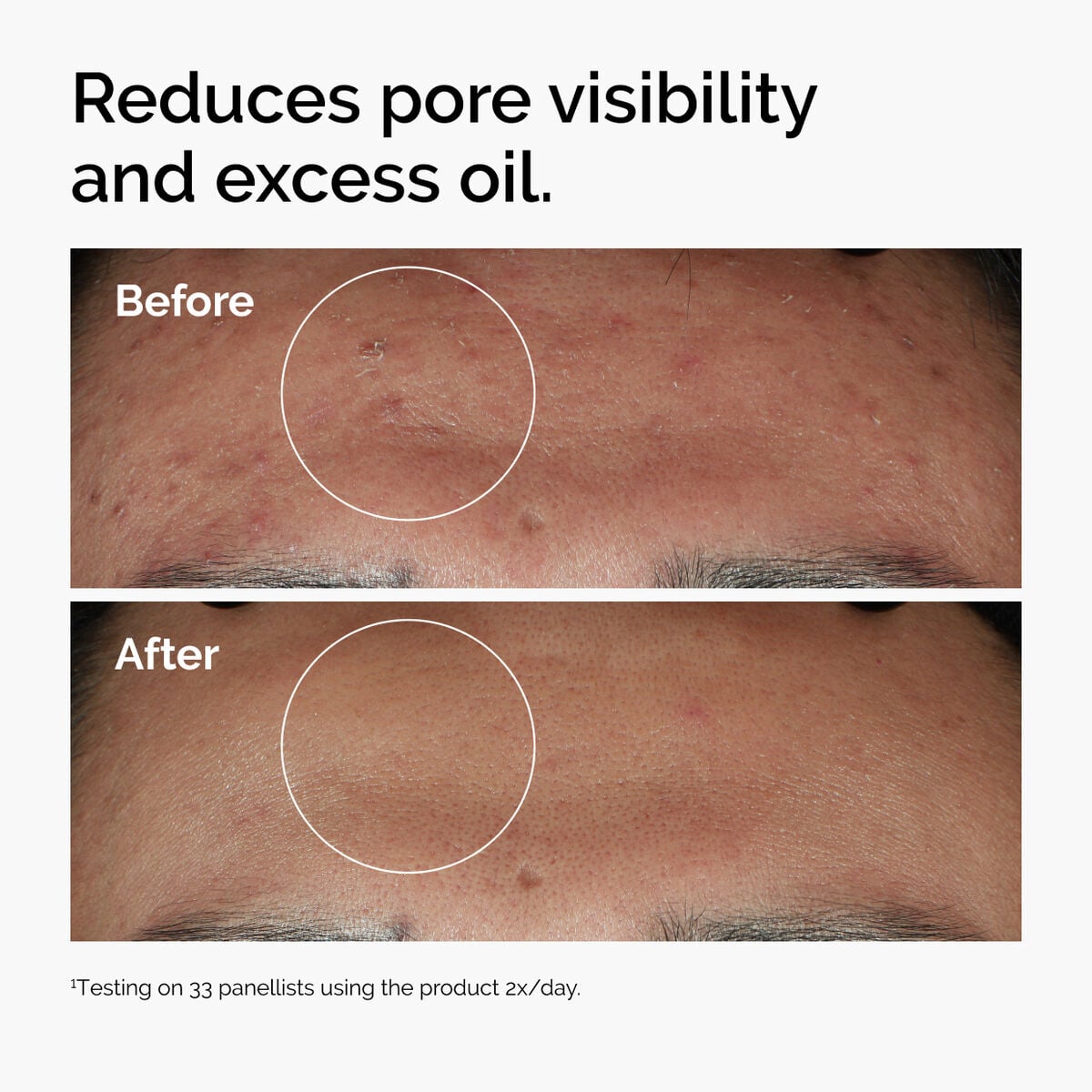 niacinamide-10-zinc-1-t9 ord-niacinamide-zinc-blemish-serum-before-after-pores.jpg