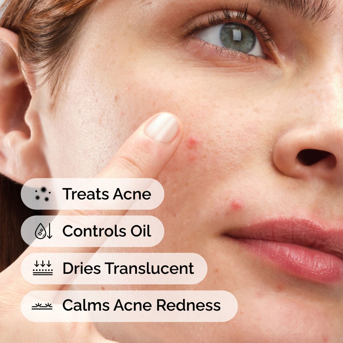 sulfur-10-powder-to-cream-concentrate-y6 ord-sulfur-10pct-powder-to-cream-concentrate-model-application-with-benefits-acne.jpg